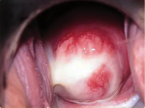 Chlamydia trachomatis en cervix