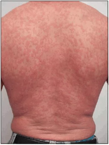 Erupción cutanea por vih