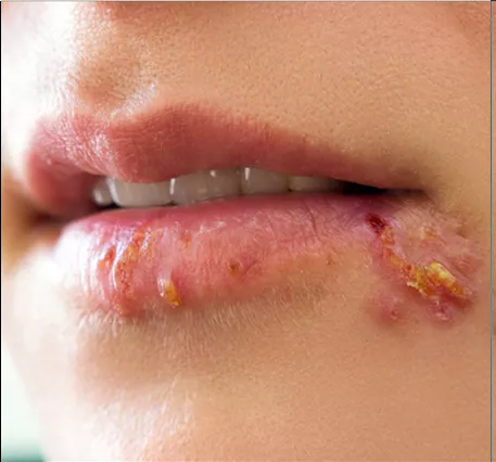 Herpes simple