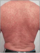 Erupción cutanea por vih