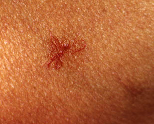 Fotografía de una araña vascular, alteración de la piel y venas, que se enrojecen Fotografía de una araña vascular, alteración de la piel y venas, que se enrojecen