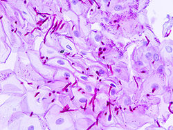 Candidiasis esofágica Candidiasis esofágica